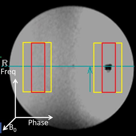 Comparison Of The Artifacts Caused By Metallic Implants In Breast Mri