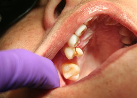 Fractured Tooth Before And After McFarlane Dental