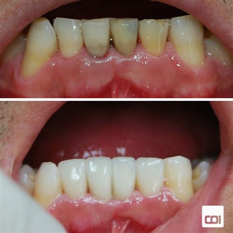 Cl Nica Dental En Gij N Caso De Implantes Dentales Y Carillas