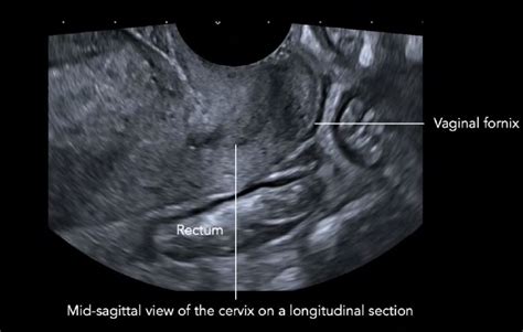 Ultrasound Features Of Uterosacral Ligaments On Transvaginal Scanning