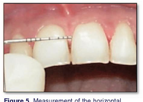 Surgical Reconstruction Of Interdental Papilla Using Subepithelial