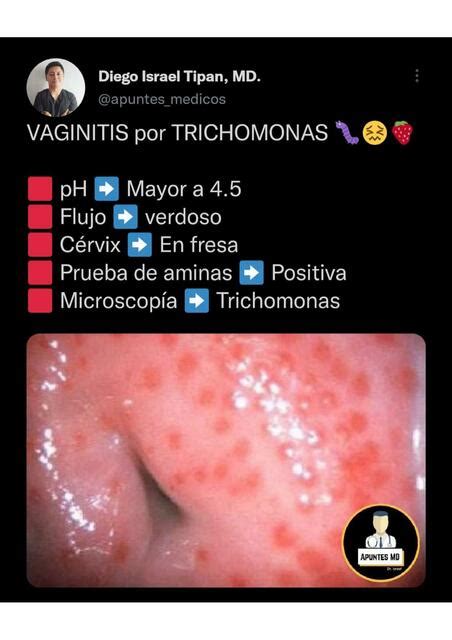 Vaginitis Por Trichomonas Apuntes M Dicos Dr Israel Apuntes