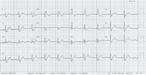 Left Posterior Fascicular Block Lpfb • Litfl • Ecg Library Diagnosis