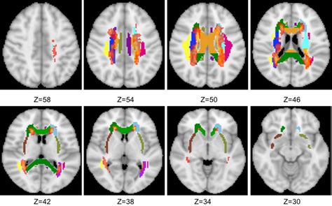 Explain Multiple Sclerosis Brain Mri