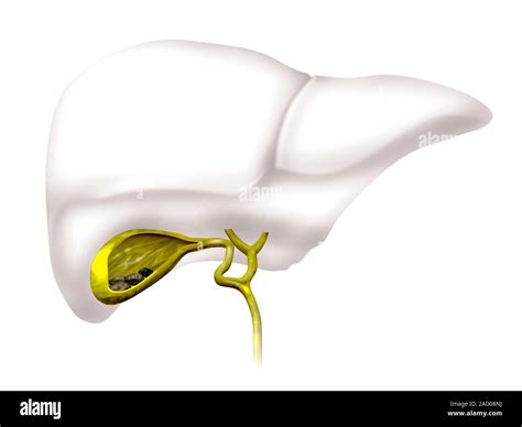 Gallstones Cutaway Computer Illustration Showing Gallstones Black In