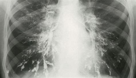 Airway Clearance Techniques For Bronchiectasis Evidence Gap Students