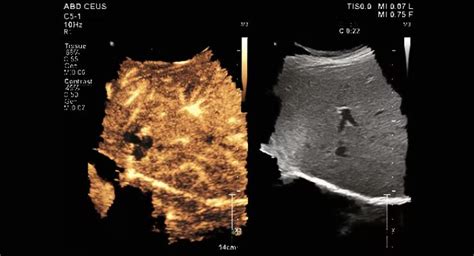 Philips Releases Contrast Enhanced Ultrasound For Epiq Elite Medical