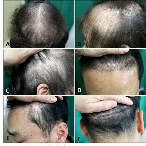 Figure 2 From Localized Telogen Effluvium Following Hair Transplantation Semantic Scholar