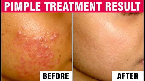 Pigmentation And Best Acne Scars Treatment Patient Success Story