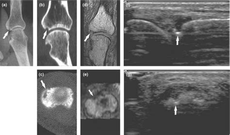 Radiography Ct Mri And Us Of A Ra Patient S 2nd Mcp Joint A Download Scientific Diagram