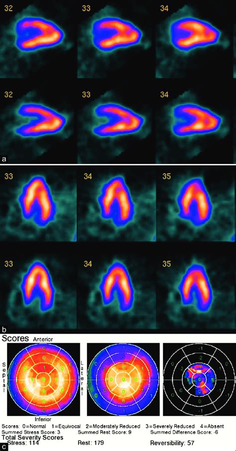 The Singlephoton Emission Computed Tomography Images A