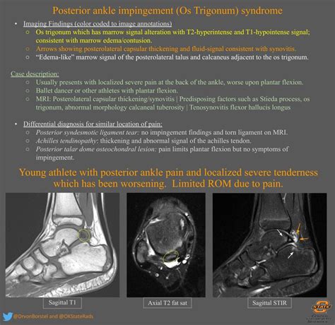 Posterior Ankle Impingement (Os Trigonum) Syndrome ...