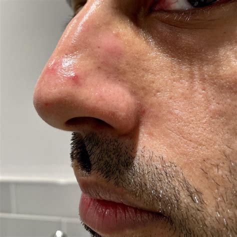 Nose Is Red Bumpy And Blotchy Please Help R30plusskincare