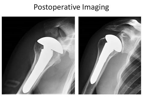 Boston Shoulder Institute Postopfinal