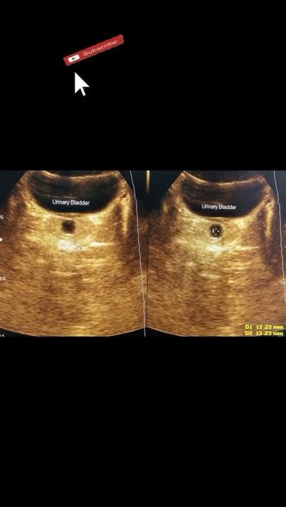 Prostatic Utricle Cyst Ultrasound Shorts Youtube