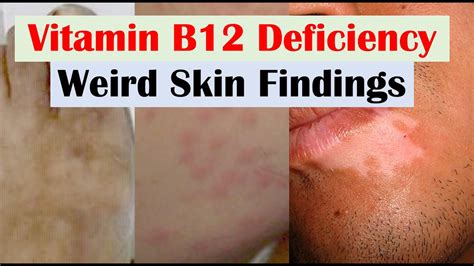 Vitamin B12 Deficiency Weird Skin Findings And Hair And Nails Youtube