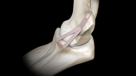 Elbow Medial Ulnar Collateral Ligament Injuries Ucl Reconstruction Using The Docking Technique