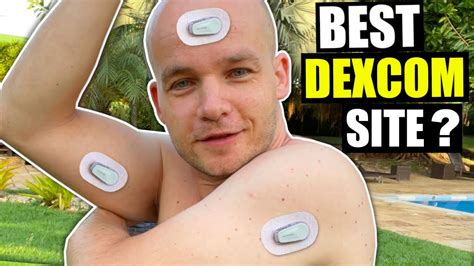 Best Sites For Dexcom G Sensor Placement Youtube