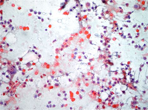 Cytopathology of lymph nodes-FNAC | Cellnetpathology