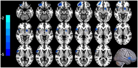 Frontiers Aberrant Brain Entropy In Posttraumatic Stress Disorder