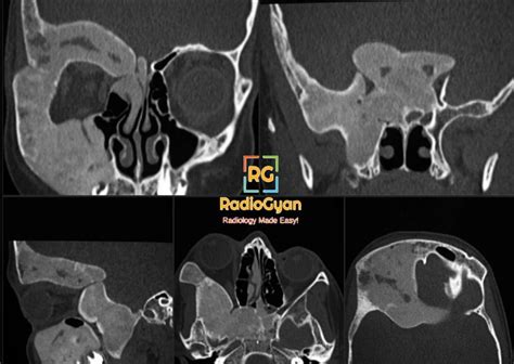 Fibrous Dysplasia Radiology Case Radiogyan
