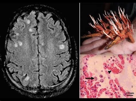 Zombie Fungus Discovered, Over Half Population Already Infected & Don't Even Know It : conspiracy