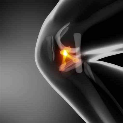 Rupture des ligaments croisés qu est ce que c est Chirurgie