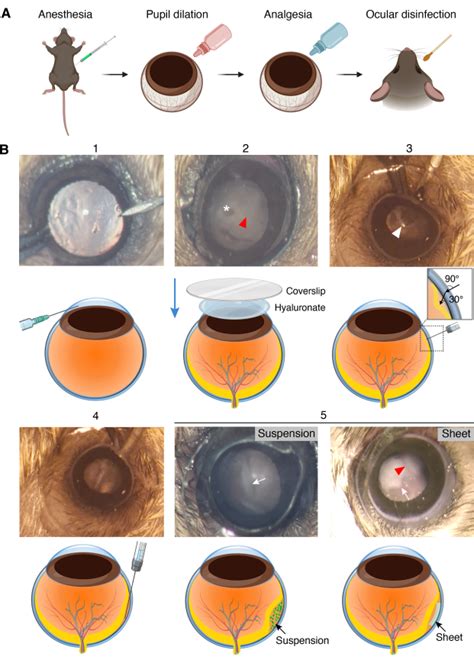 Transpupillary Guided Trans Scleral Transplantation Of Subretinal