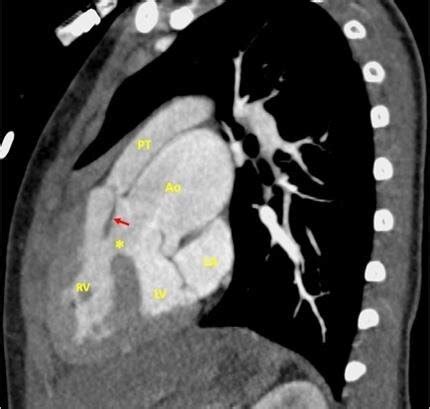 Echocardiogram in subcostal view (A) and catheter angiogram in ...