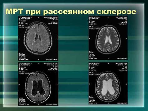 Рассеянный склероз Диагностика и дифференциальная диагностика Рассеянный