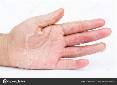 Dry Hands