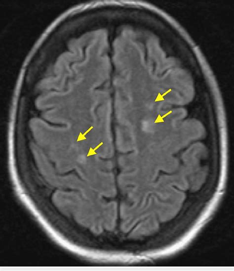 Flair Sequence On Brain Mri Depicting Multiple Hyperintense Signal Foci