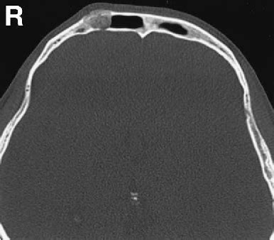 Figure From Intraosseous Cavernous Hemangioma Of The Frontal Bone