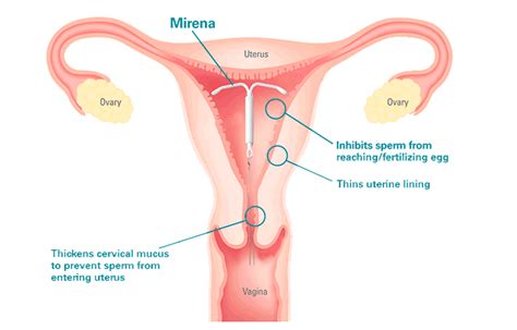 Hormone Releasing Iud Mirena Warrandyte Road Clinic Ringwood