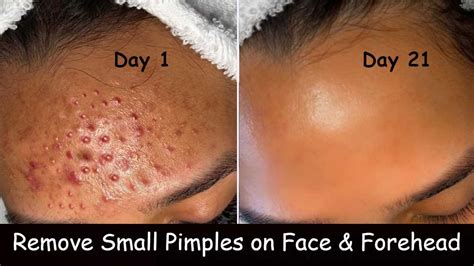 Unique Info About How To Get Rid Of Tiny Pimples Petertrade29