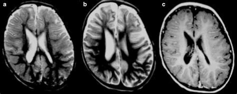 SSPE. A 6-year-old female patient with progressive cognitive decline ...