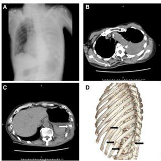 Chest radiography and computed tomography imaging findings of the ...