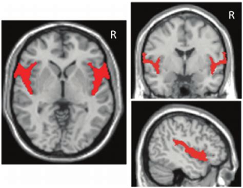 Tracing of the region of the Sylvian fissure overlaid on three... | Download Scientific Diagram