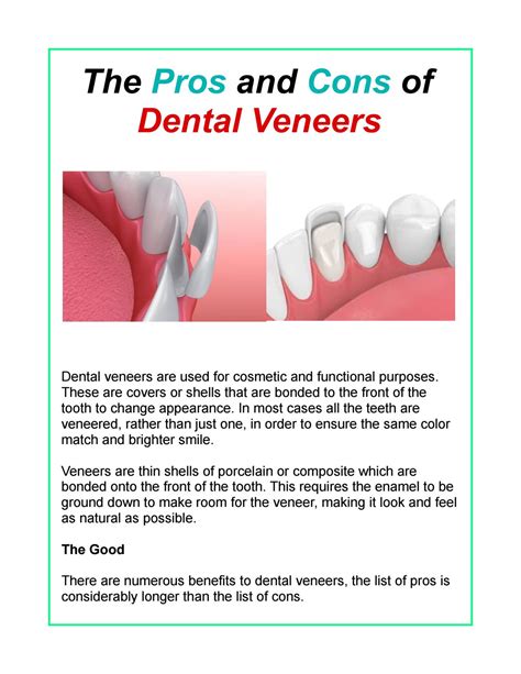 Composite Veneers Pros And Cons