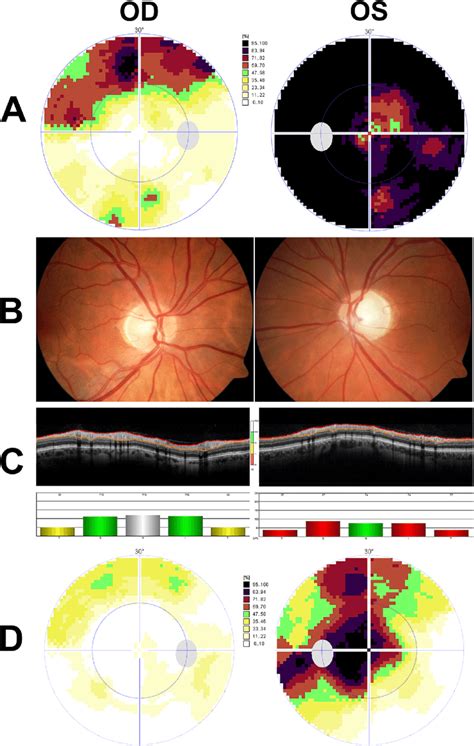 Threshold Perimetry A Fundus Photography B And Optical Coherence