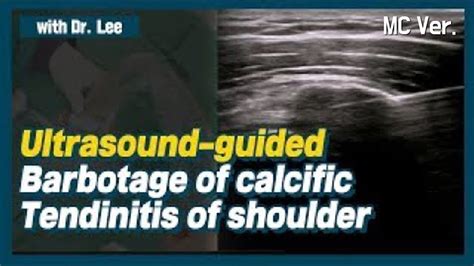 Mcultrasound Guided Lavage Of Calcific Tendinitis Of Shoulderdense