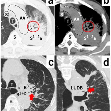 A B Axial Chest Ct Scans With Lung A And Mediastinal B Windows