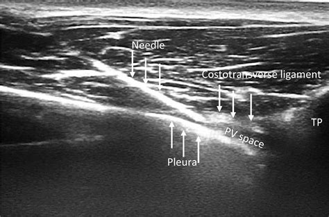 Comparison Of The Results Of Ultrasound Guided Thoracic Paravertebral