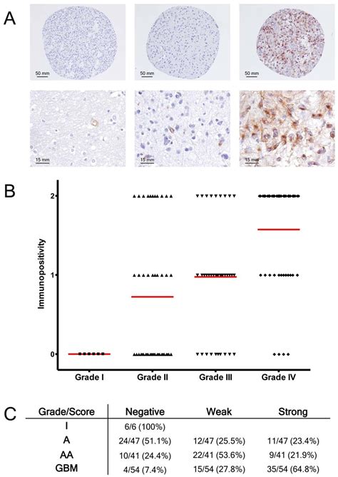 Immunohistochemical Analysis Of Podxl Expression In Gliomas A