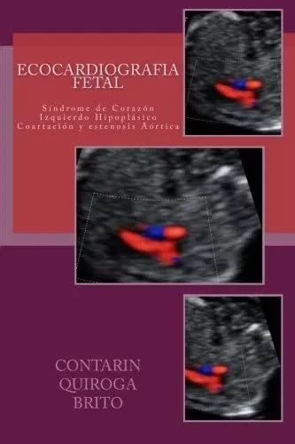 Libro Ecocardiografia Fetal Sindrome De Coraz N Izquierdo Env O Gratis