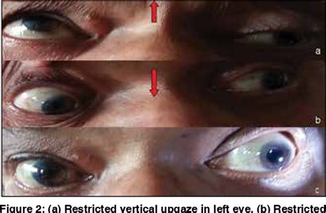 Figure From A Surprising Cause Of Isolated Oculomotor Nerve Palsy