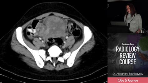 Ovarian Torsion Radiology Review Course Youtube