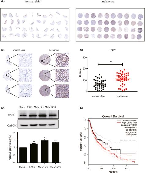 Usp Is Overexpressed And Correlates With Poor Prognosis In Melanoma