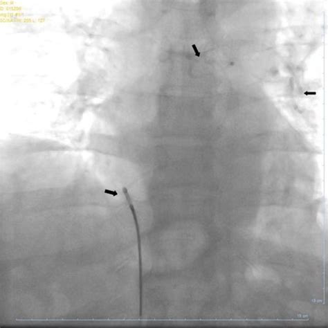 Kub After Placement Of Dj Stent In Right Ureter Download Scientific