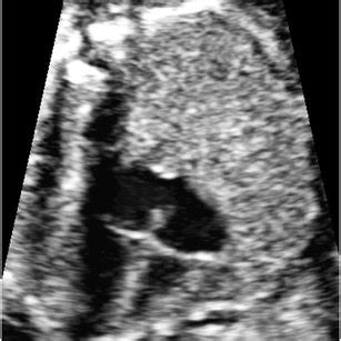 Fetal Lung Interstitial Tumor Case 3 Histology Shows Diffuse